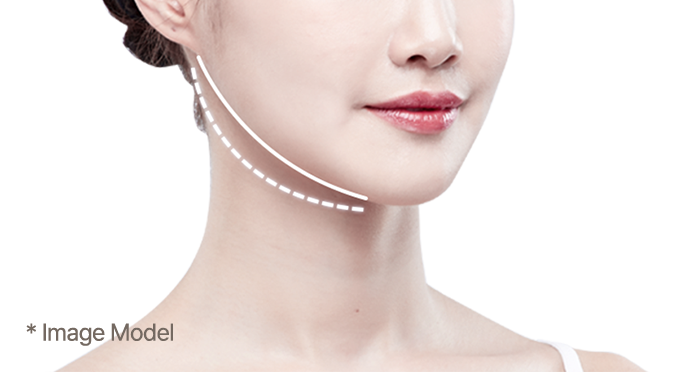 square jaw surgery